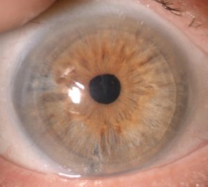 distrofia endoteliale ereditaria (CHED)