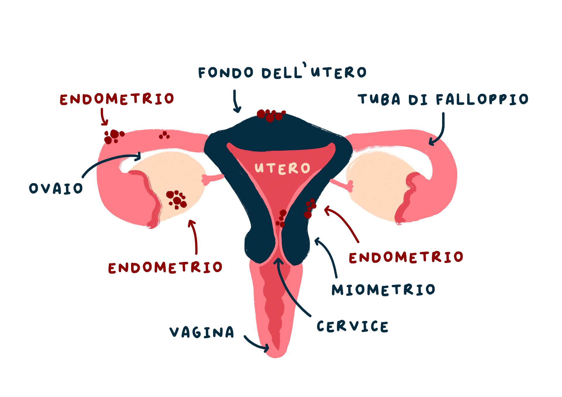 Endometrio